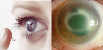 fusarium disease-eye